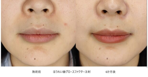 20代女性 症例11のほうれい線治療写真