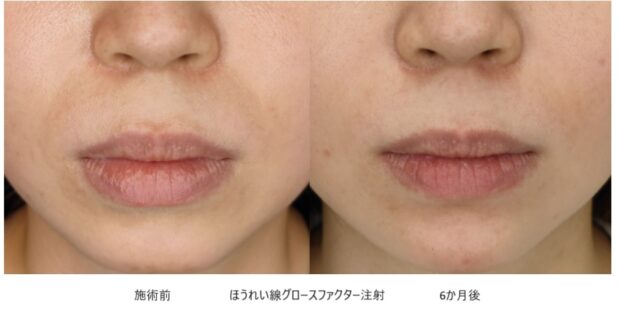 30代女性 症例32のほうれい線治療写真
