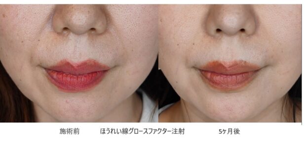 40代女性 症例32のほうれい線治療写真