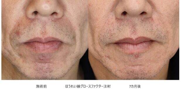 50代男性 症例6のほうれい線治療写真