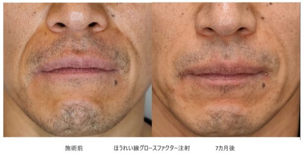 50代男性 症例5のほうれい線治療写真