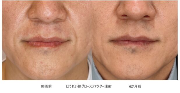 40代男性 症例6のほうれい線治療写真