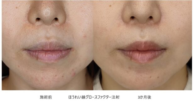 30代女性 症例33のほうれい線治療写真