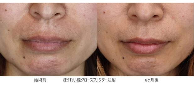 40代女性 症例33のほうれい線治療写真