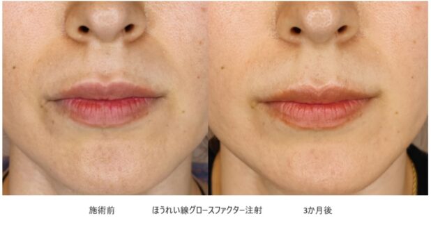30代女性 症例31のほうれい線治療写真