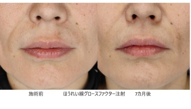 40代女性 症例34のほうれい線治療写真