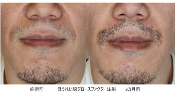 40代男性 症例5のほうれい線治療写真