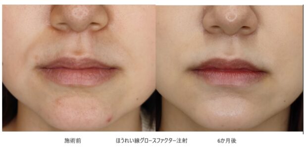 20代女性 症例12のほうれい線治療写真