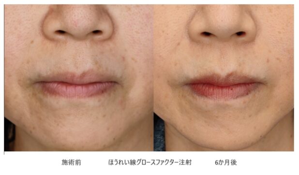 50代女性 症例34のほうれい線治療写真