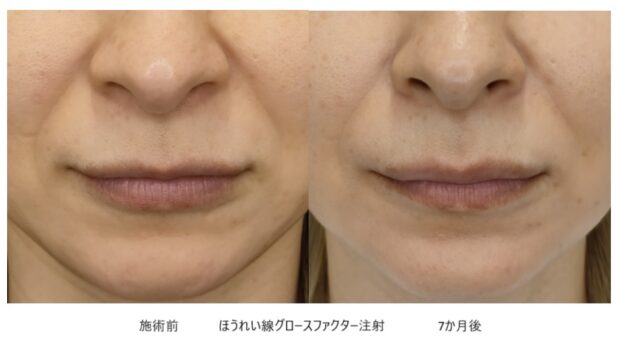 30代女性 症例35のほうれい線治療写真