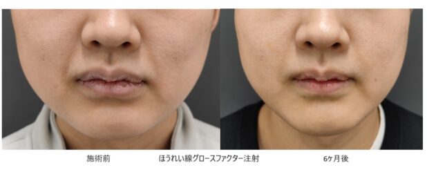 20代男性 症例3のほうれい線治療写真