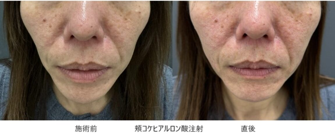 ヒアルロン酸による頬のコケ・窪み（凹み）治療⑥の症例写真