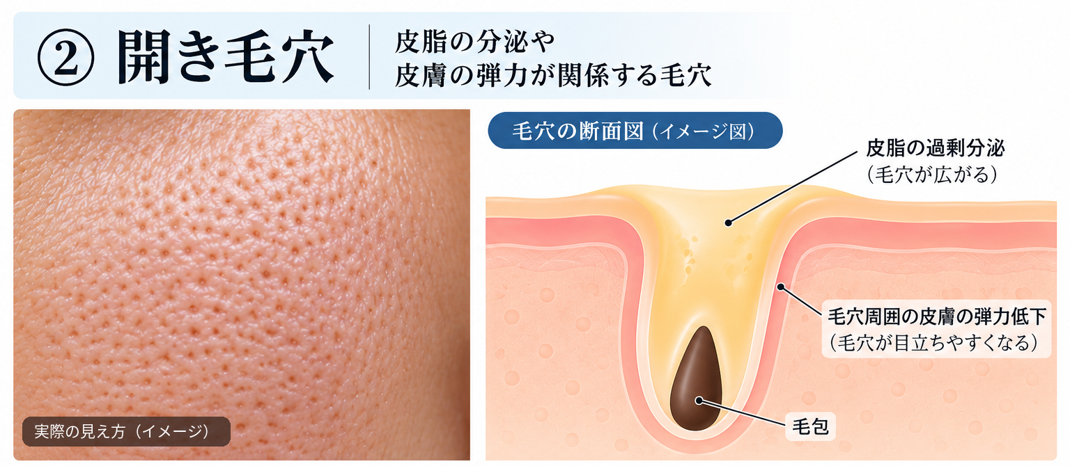 Close-up of enlarged pores on the cheek and a cross-sectional illustration showing sebum production and reduced skin elasticity