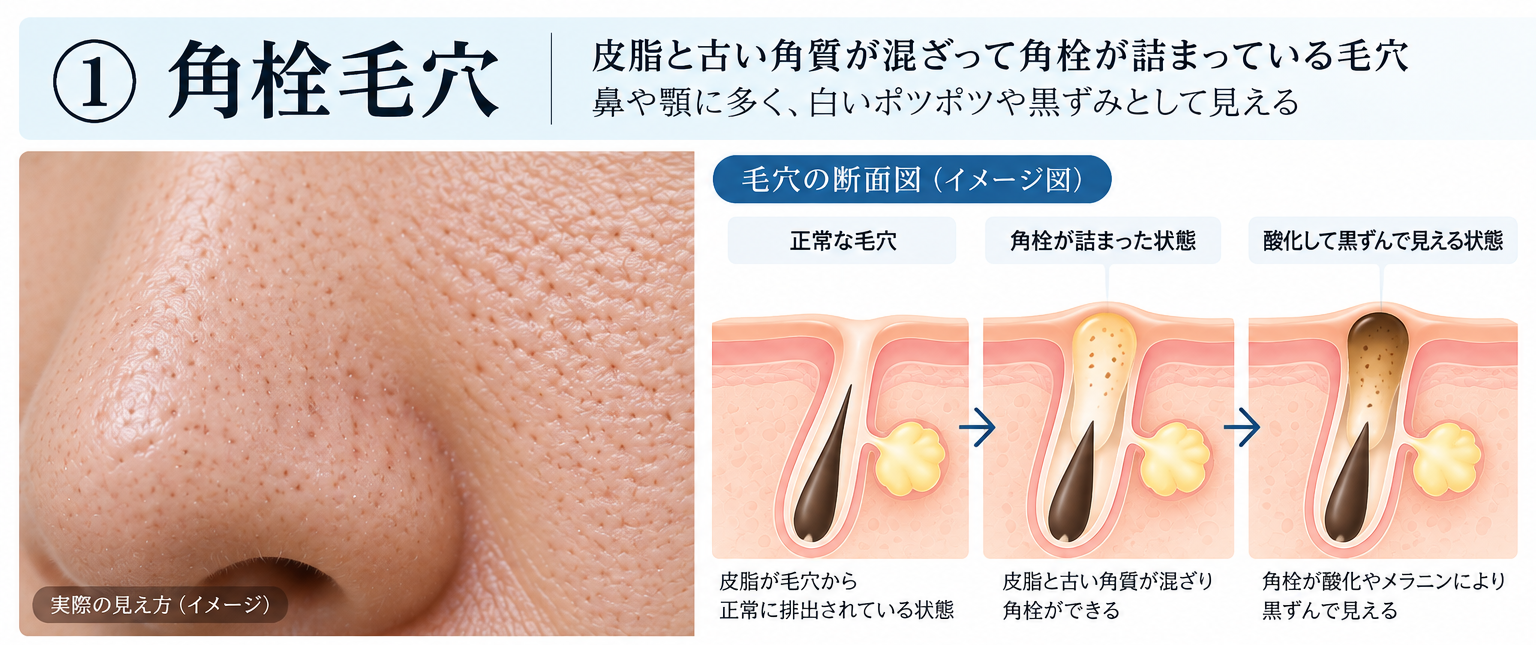 Close-up of clogged pores on the nose and a cross-sectional illustration showing keratin plugs and darkened pores