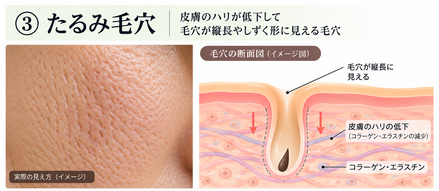 Close-up of elongated pores on the cheek and a cross-sectional illustration showing pores affected by reduced skin elasticity
