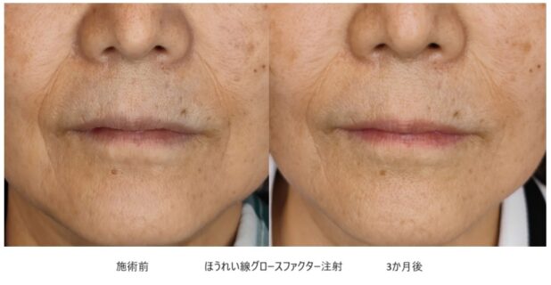 60代女性 症例6のほうれい線治療写真