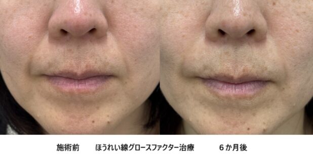 40代女性 症例37のほうれい線治療写真