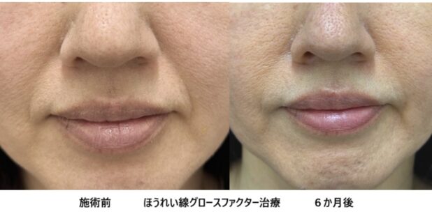 50代女性 症例35のほうれい線治療写真