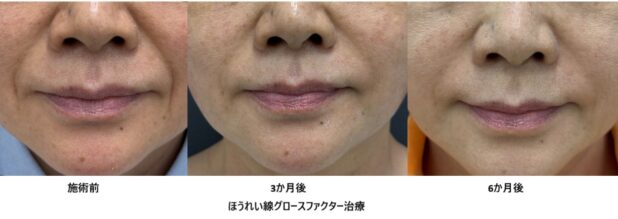 60代女性 症例7のほうれい線治療写真