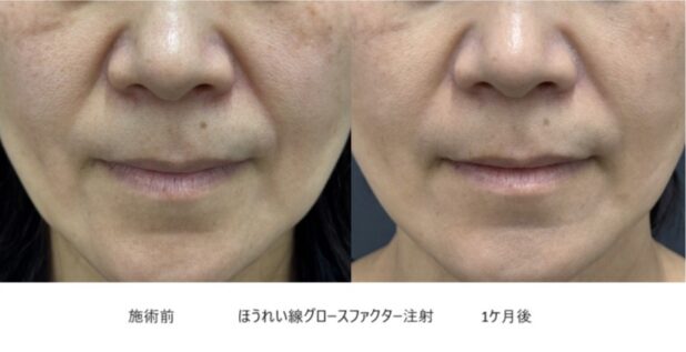 40代女性 症例36のほうれい線治療写真