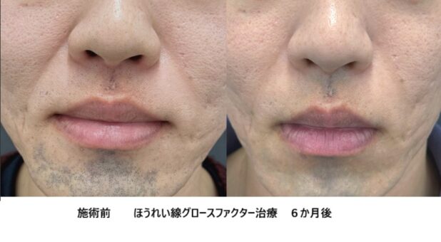 30代男性 症例8のほうれい線治療写真