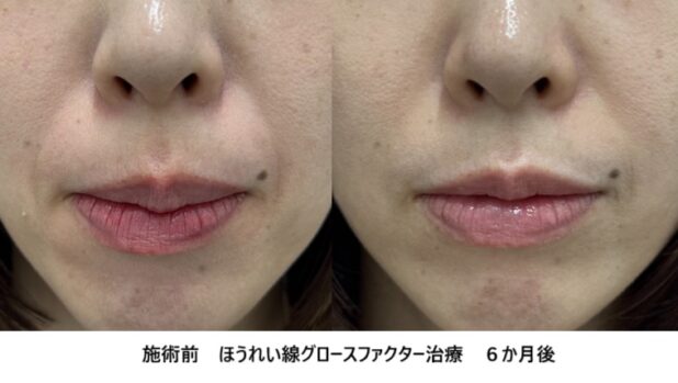 30代女性 症例37のほうれい線治療写真