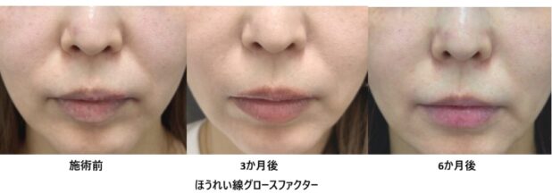 40代女性 症例38のほうれい線治療写真