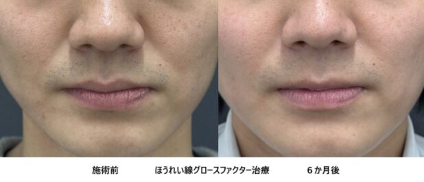 30代男性 症例9のほうれい線治療写真