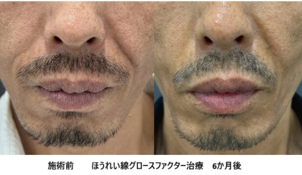 50代男性 症例7のほうれい線治療写真