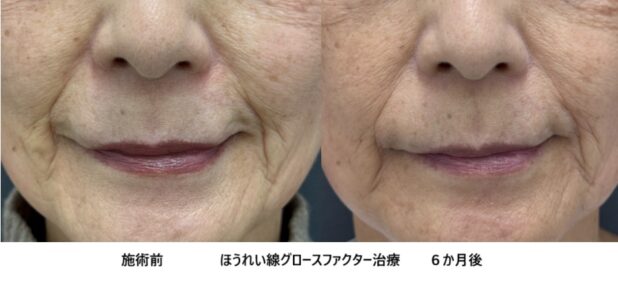 60代女性 症例8のほうれい線治療写真