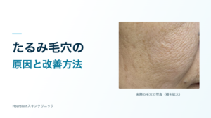 たるみ毛穴の原因と改善方法。頬の縦長の毛穴が分かる実際の写真。
