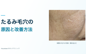 たるみ毛穴の原因と改善方法。頬の縦長の毛穴が分かる実際の写真。