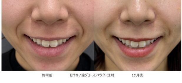 20代女性 症例13のほうれい線治療写真