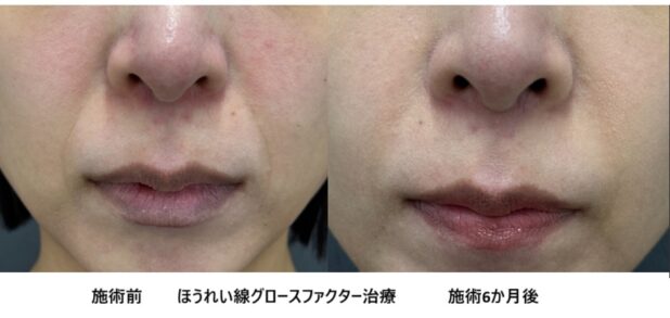 30代女性 症例44のほうれい線治療写真