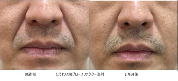 40代男性 症例7のほうれい線治療写真