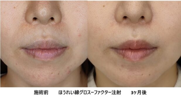 30代女性 症例34のほうれい線治療写真