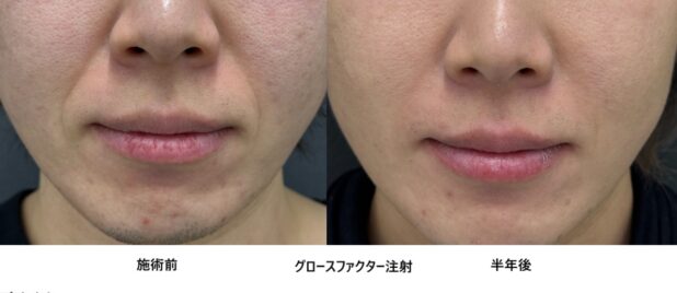 30代男性 症例10のほうれい線治療写真