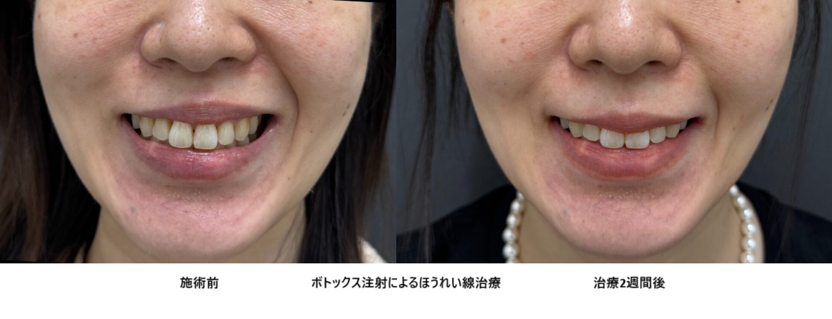 ボトックスによるほうれい線の左右差の治療の症例写真