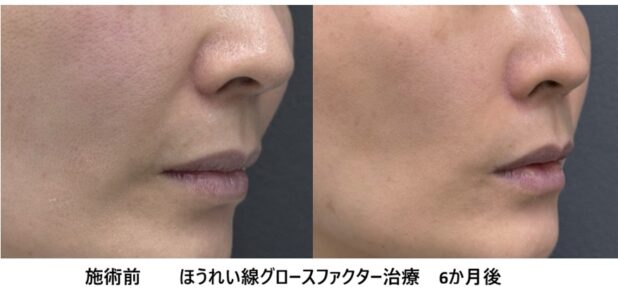 40代女性 症例39のほうれい線治療写真