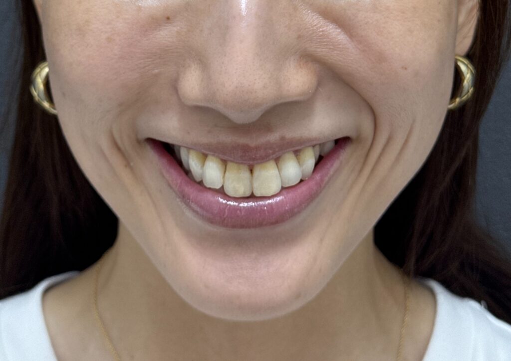 Illustration of facial expression muscles involved in smiling