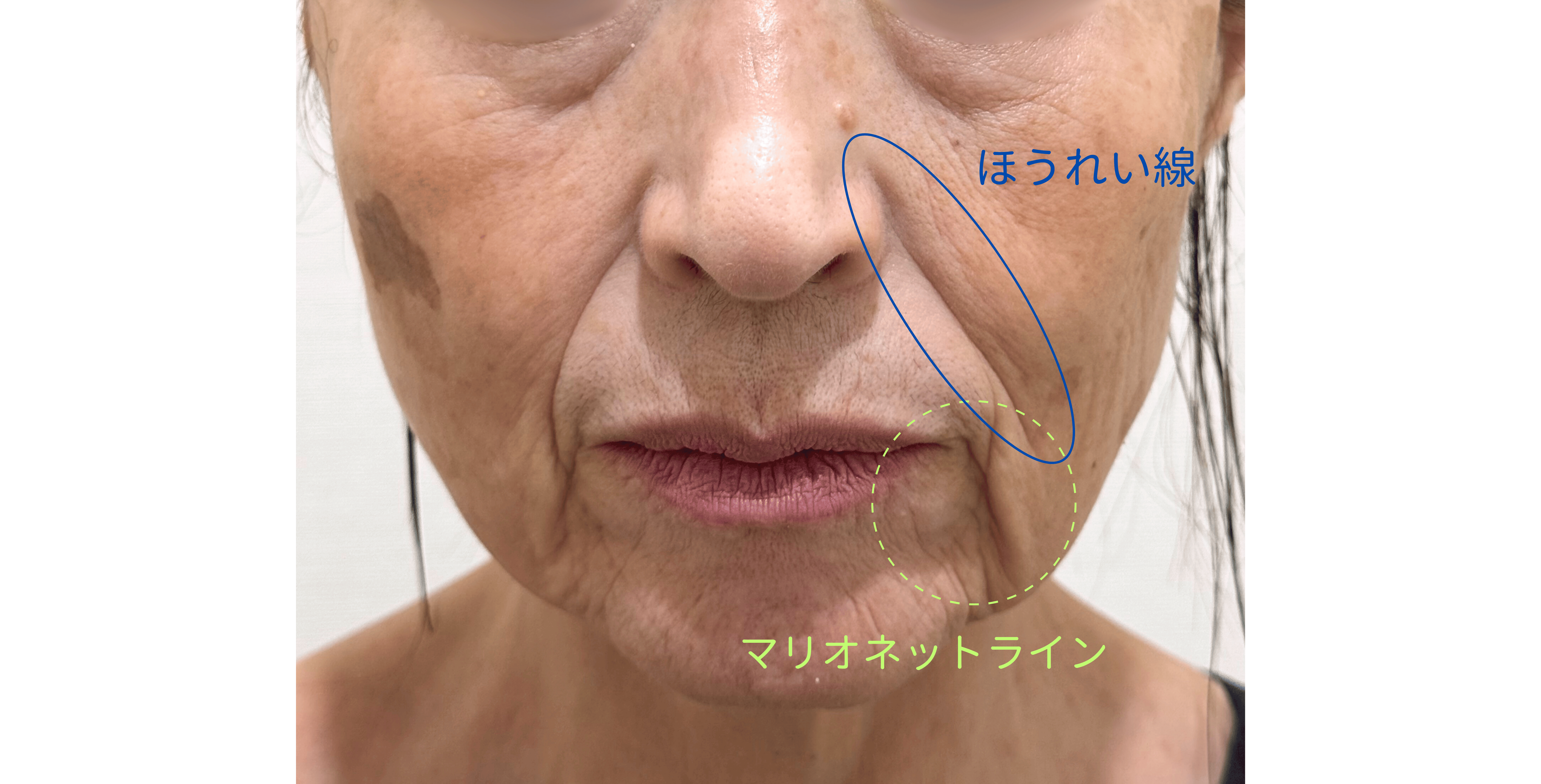 気になるほうれい線・マリオネットラインは糸リフトとヒアルロン酸でまとめてすっきり㉒の症例写真