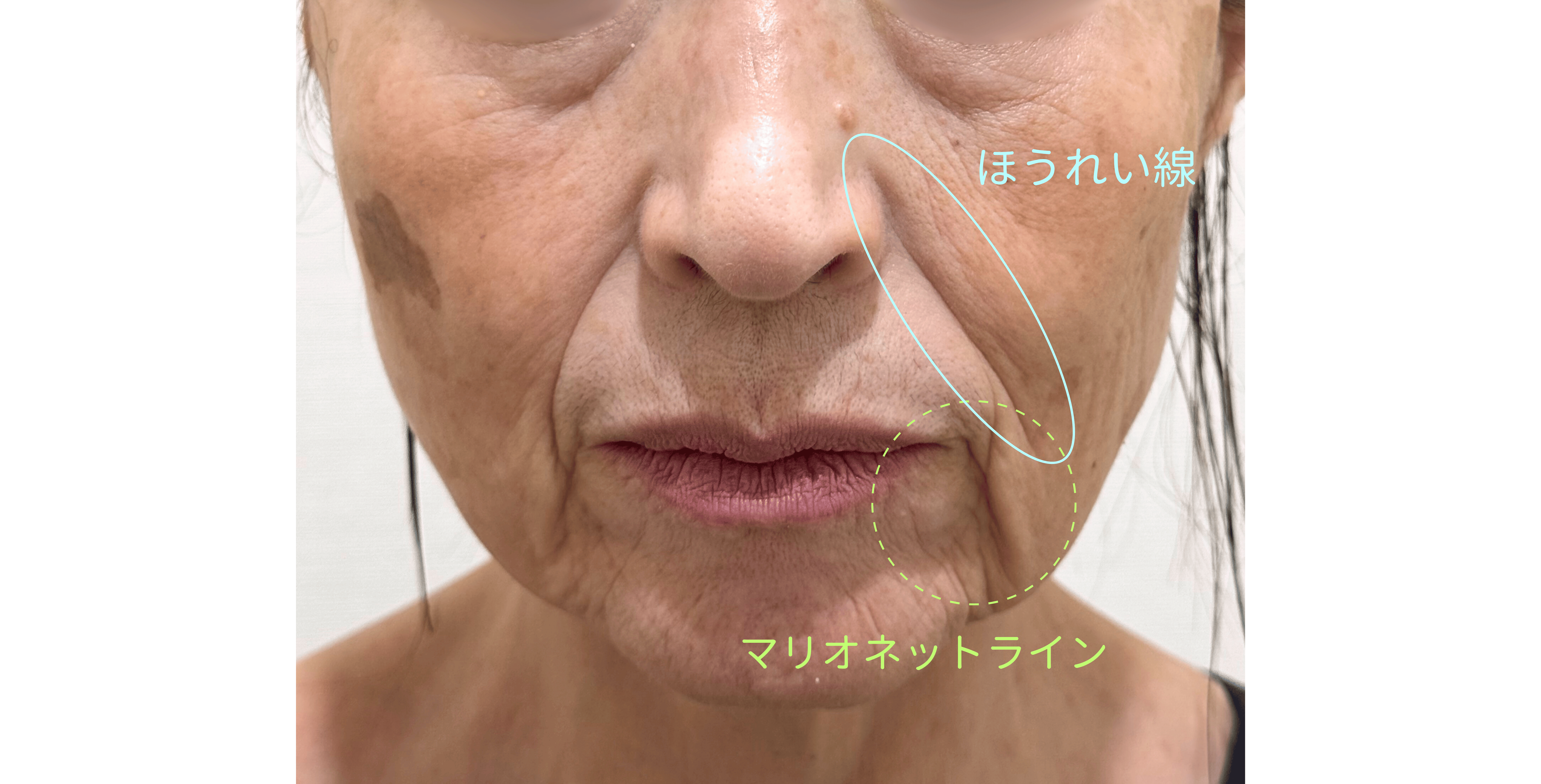 60代女性の糸リフトとヒアルロン酸治療前 正面別写真