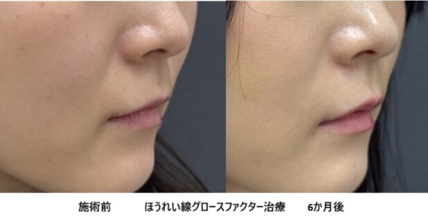 40代女性 症例40のほうれい線治療写真