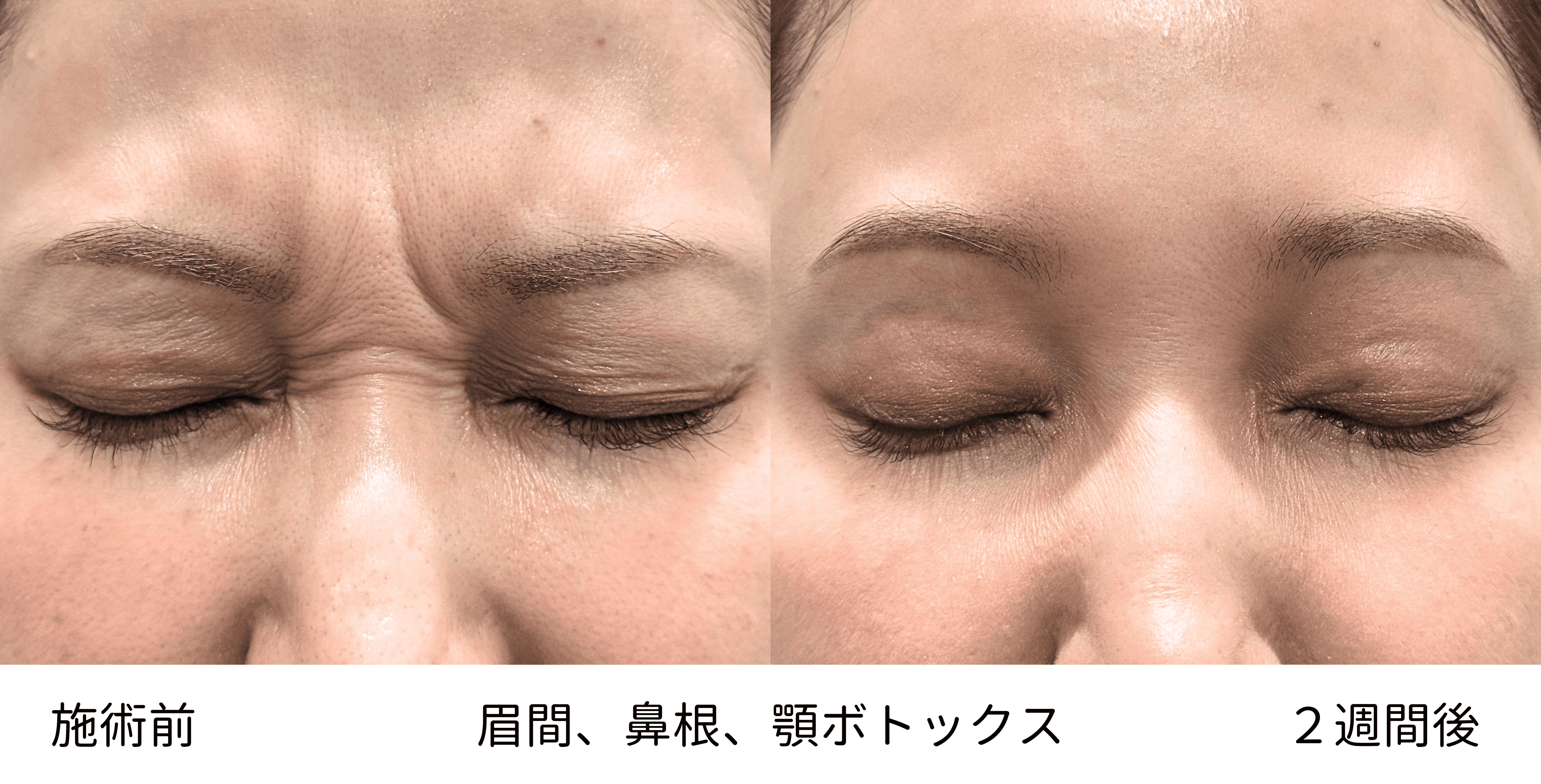 30代の“なんとなく老け見えするシワ…”を解消！眉間・鼻根・顎ボトックスで自然な若返り！の症例写真