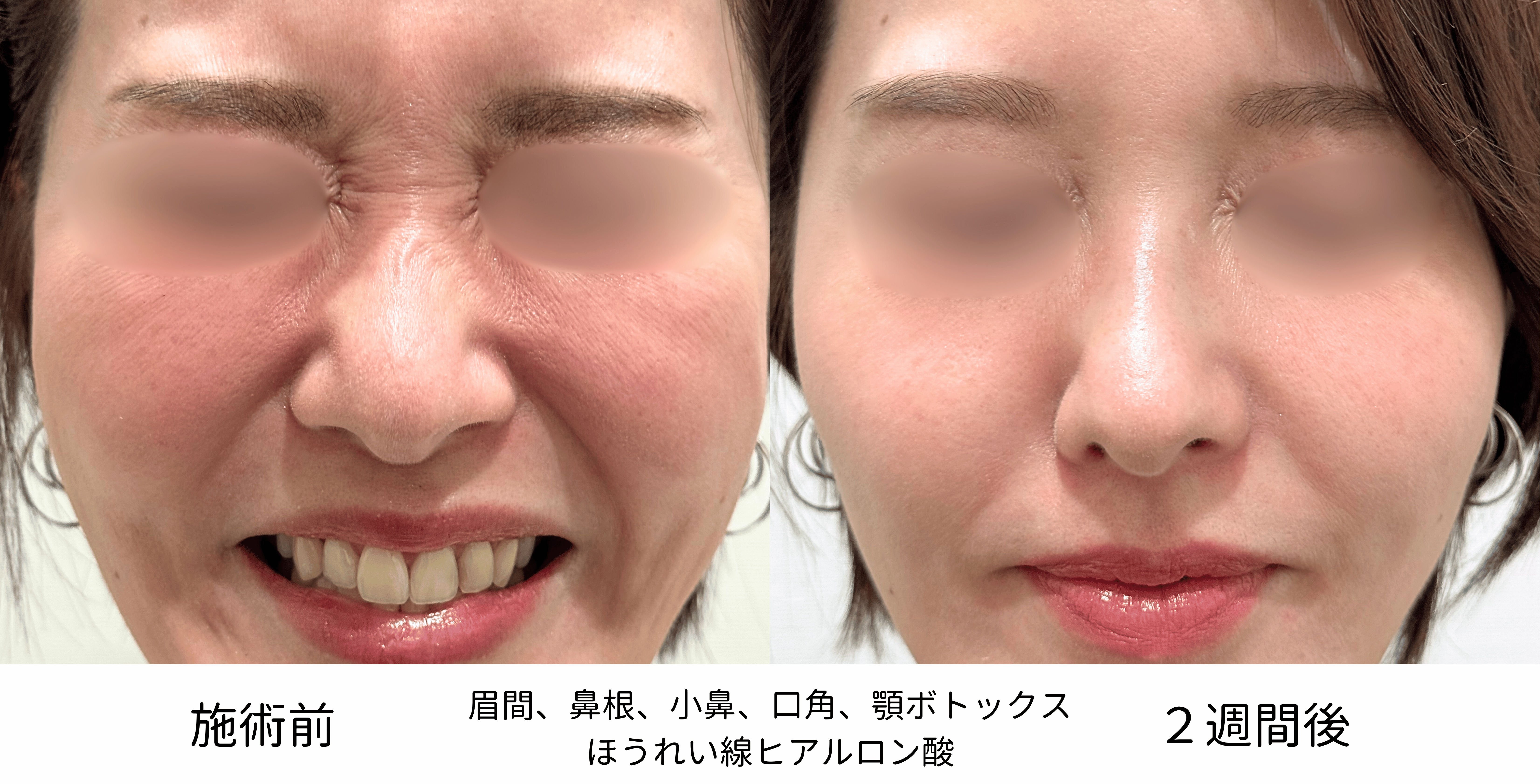 ヒアルロン酸（ほうれい線）とボトックス（眉間、鼻根、小鼻、口角、顎