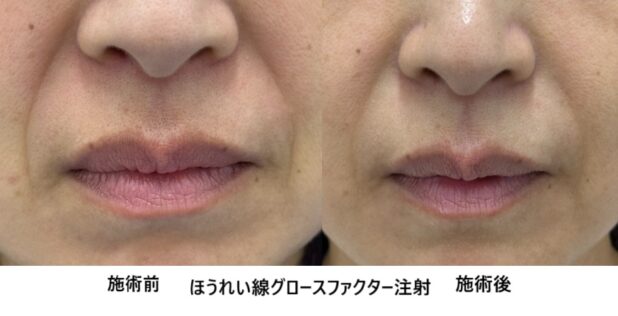 40代女性 症例41のほうれい線治療写真