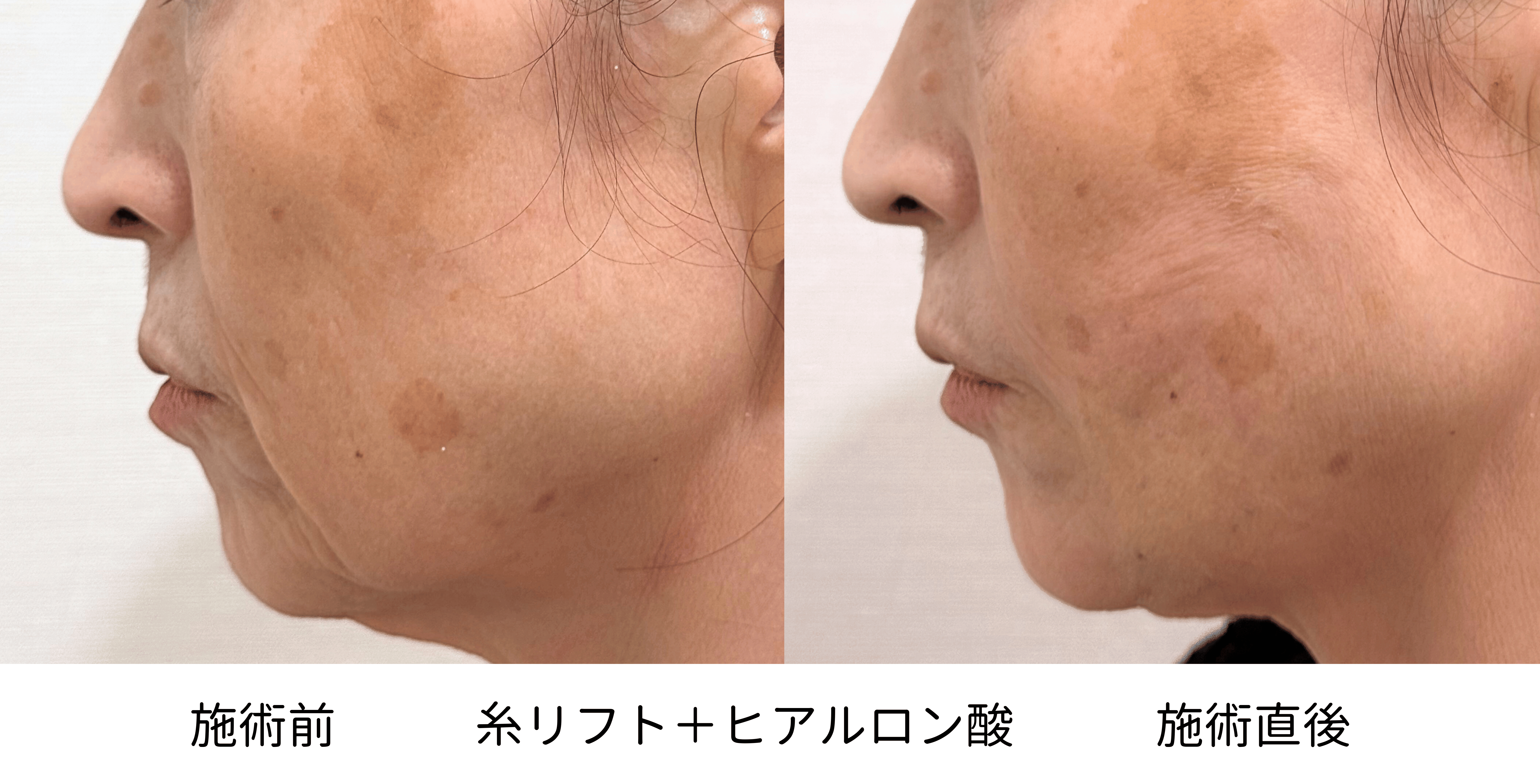 60代女性の糸リフトとヒアルロン酸治療前後の左側別比較
