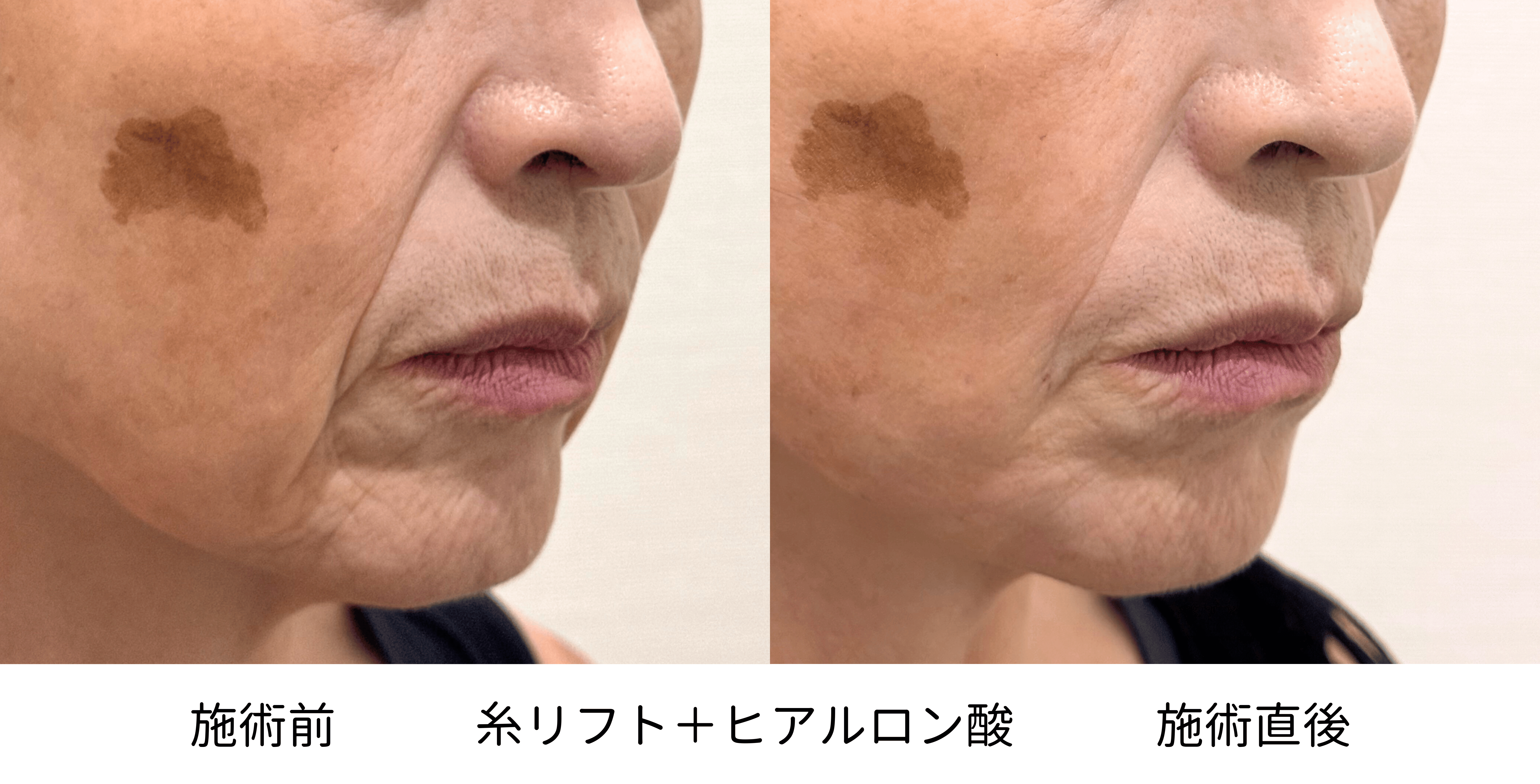 60代女性の糸リフトとヒアルロン酸治療前後の右側比較
