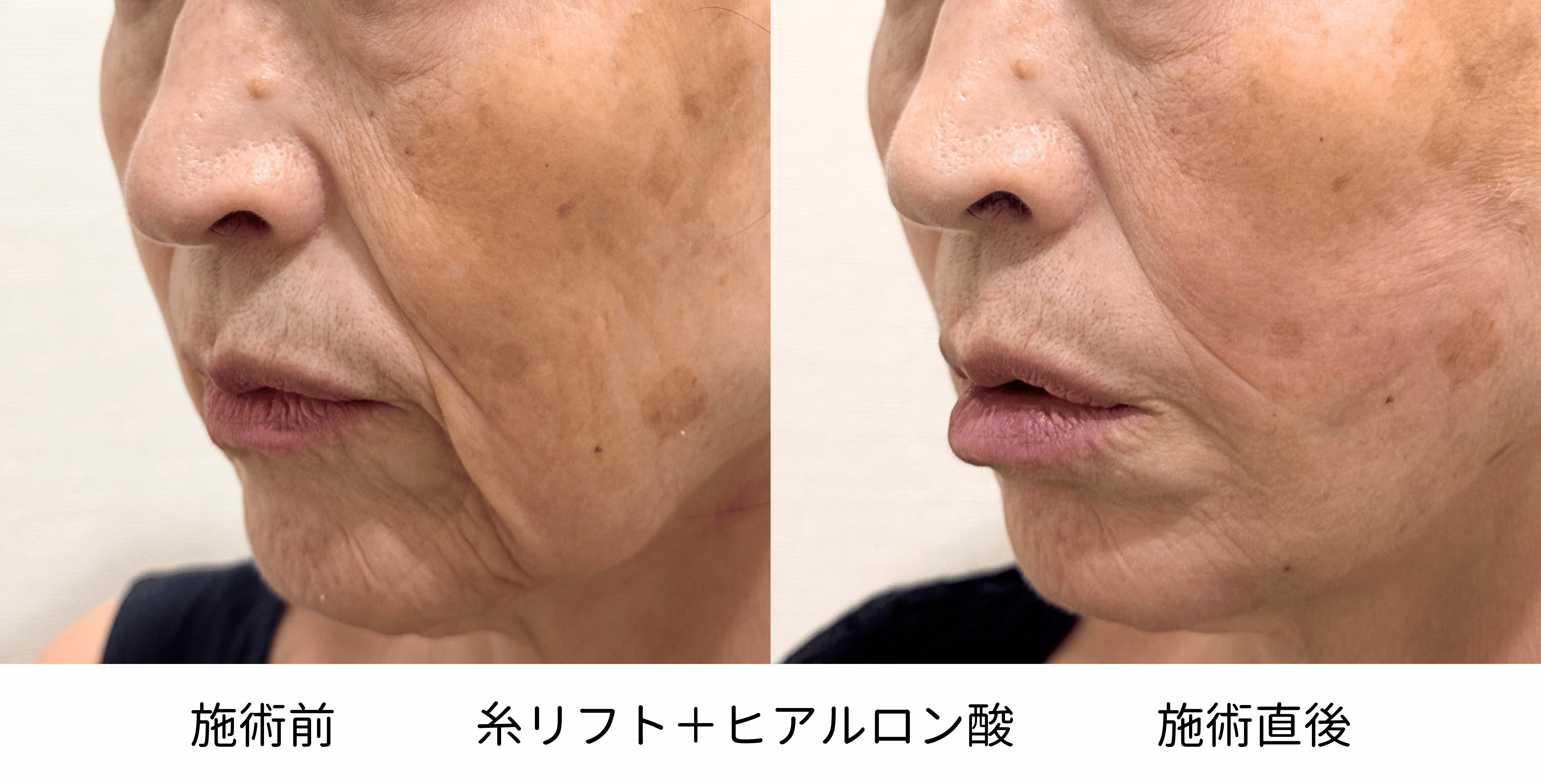 60代女性の糸リフトとヒアルロン酸治療前後の左側比較