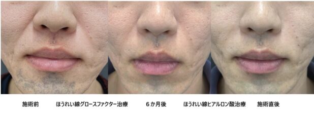 30代男性 症例15のほうれい線治療写真